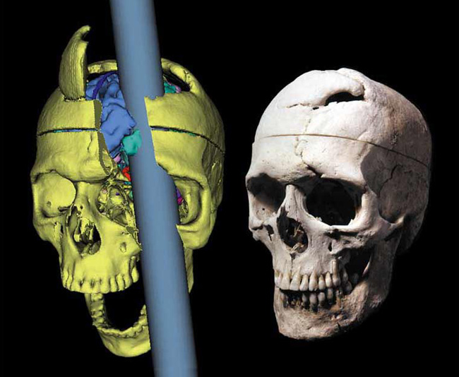 Gage skull and accident reconstruction
